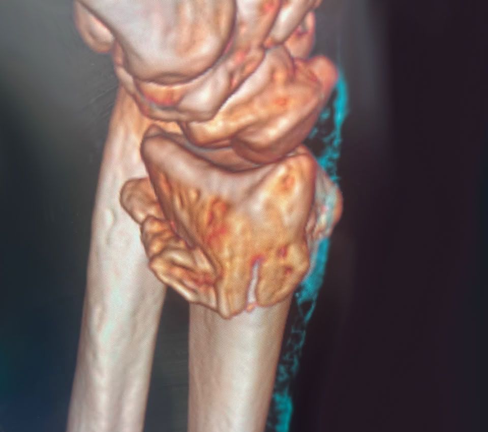 Pre-operative wrist image 1