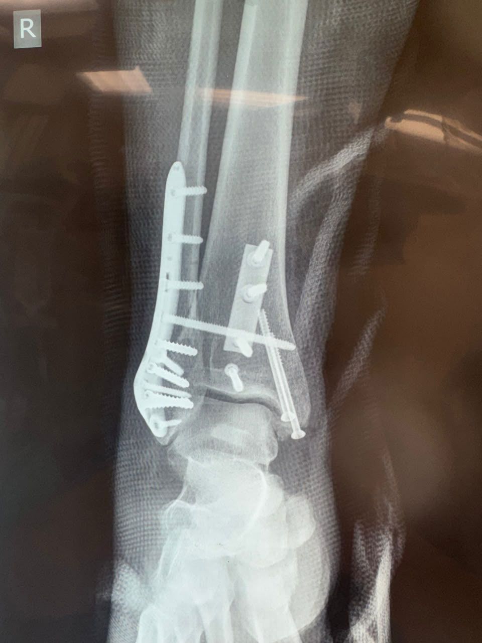 Post-operative image 1
