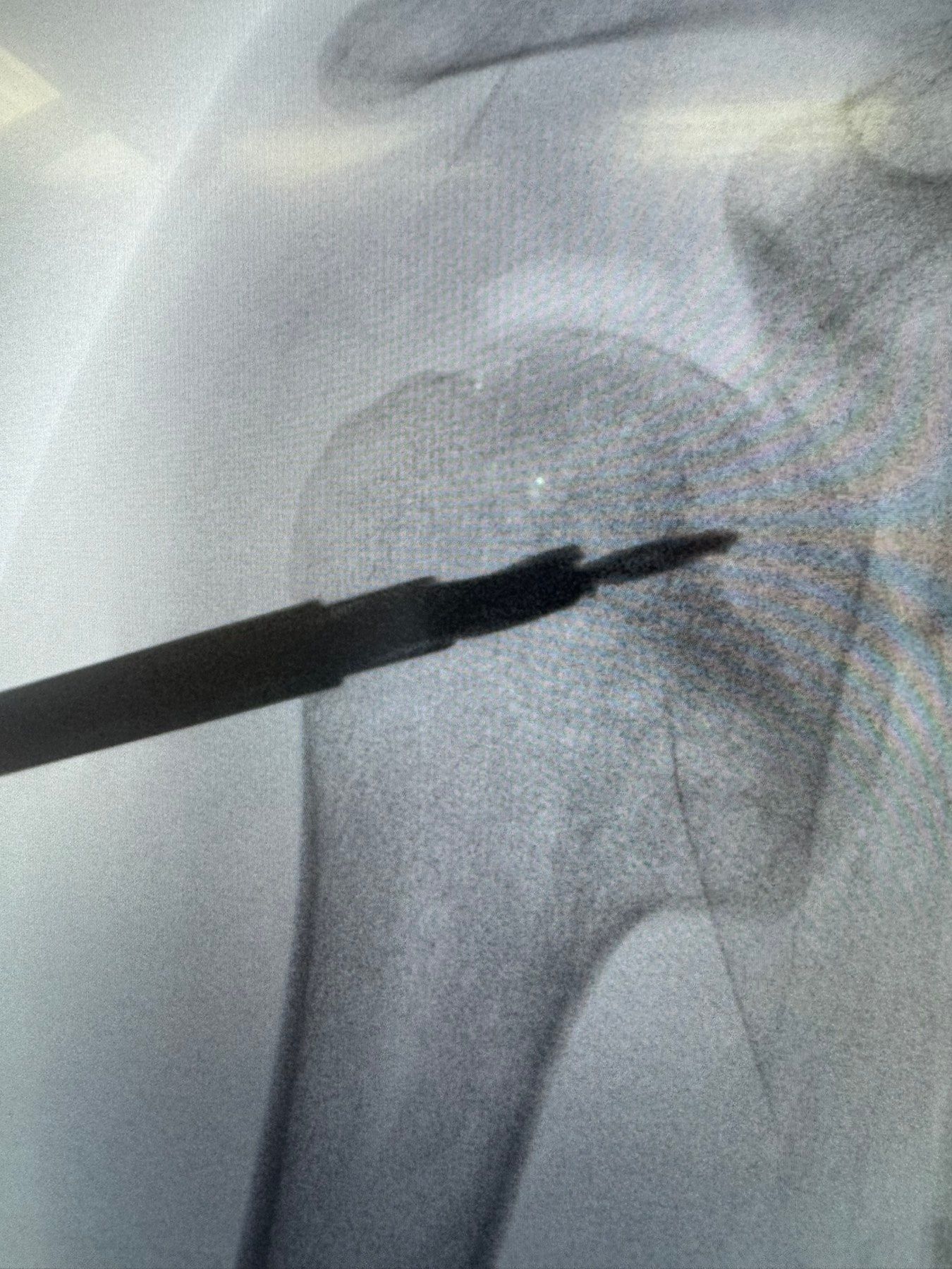 Second-look arthroscopy — final verification