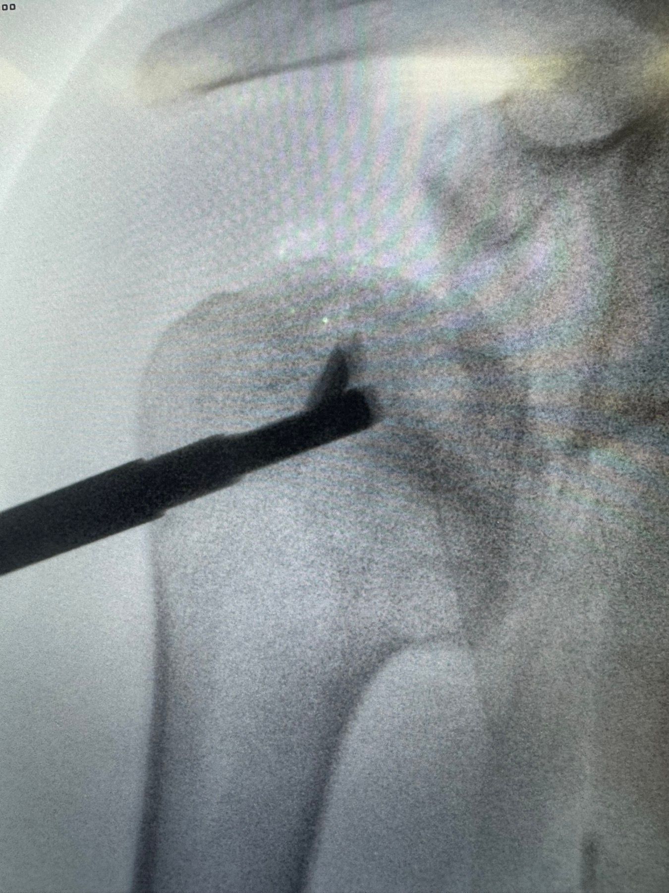 Guide wire placement — fluoroscopic control