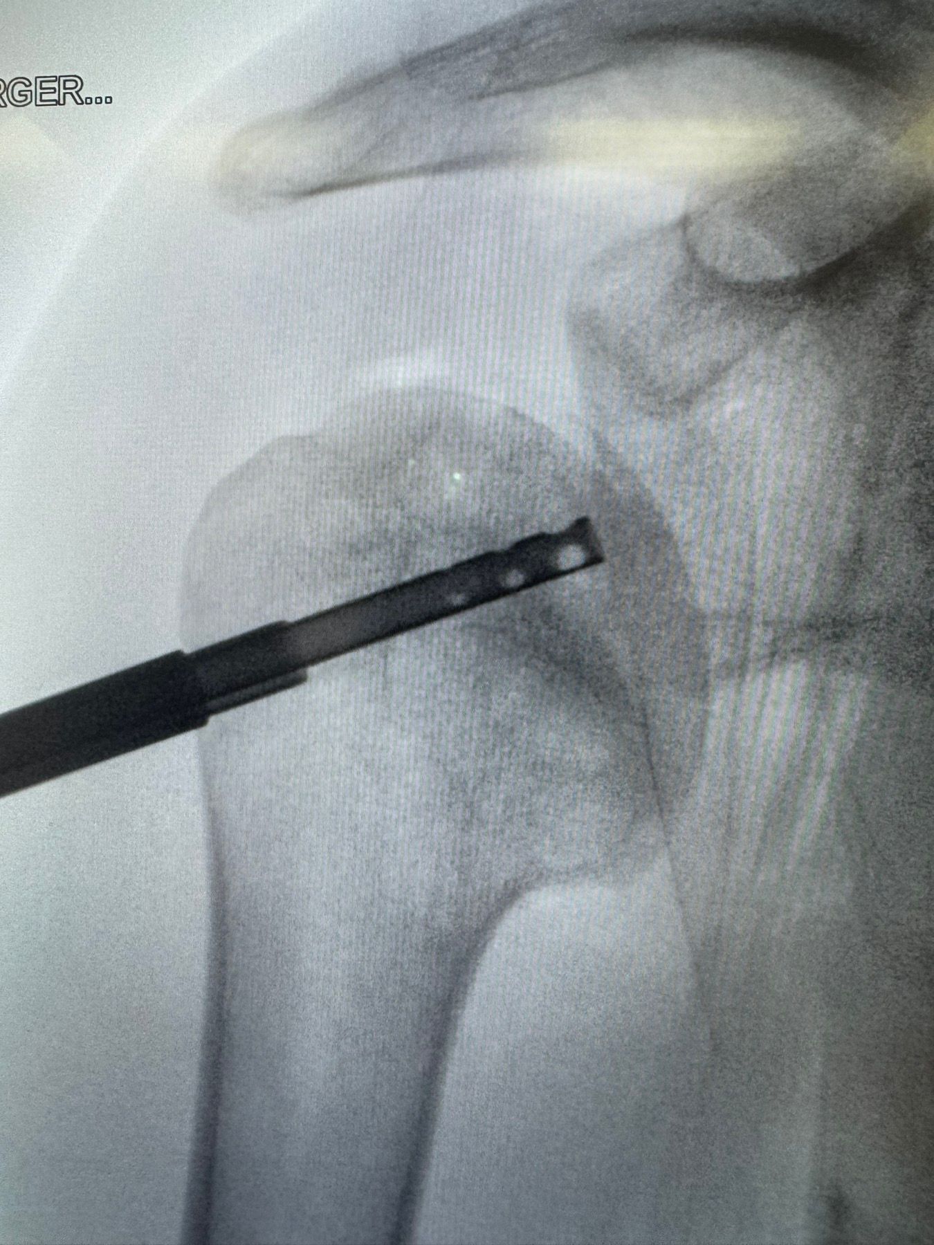 Material distribution — fluoroscopic confirmation