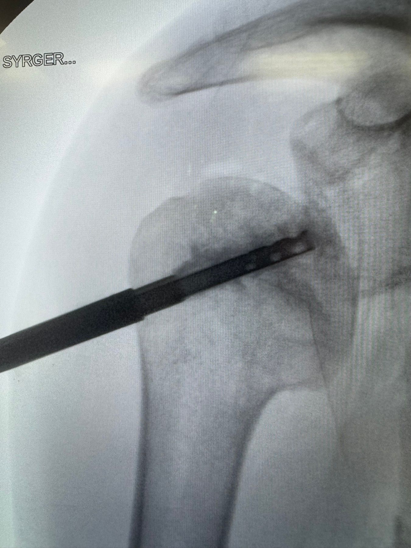 Arthroscopic inspection — joint verification