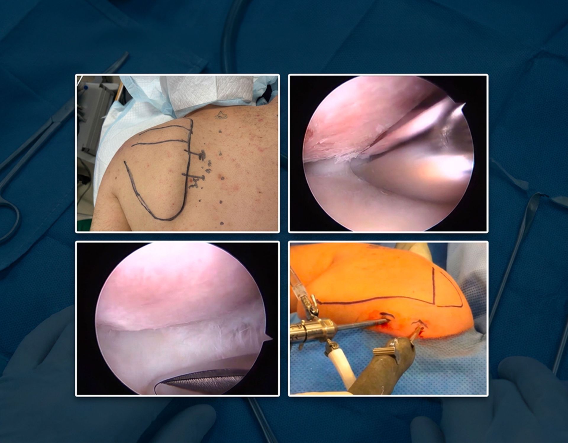Θωρακοωμοπλατιαίο σύνδρομο (Snapping Scapula) – αρθροσκοπική εικόνα 1