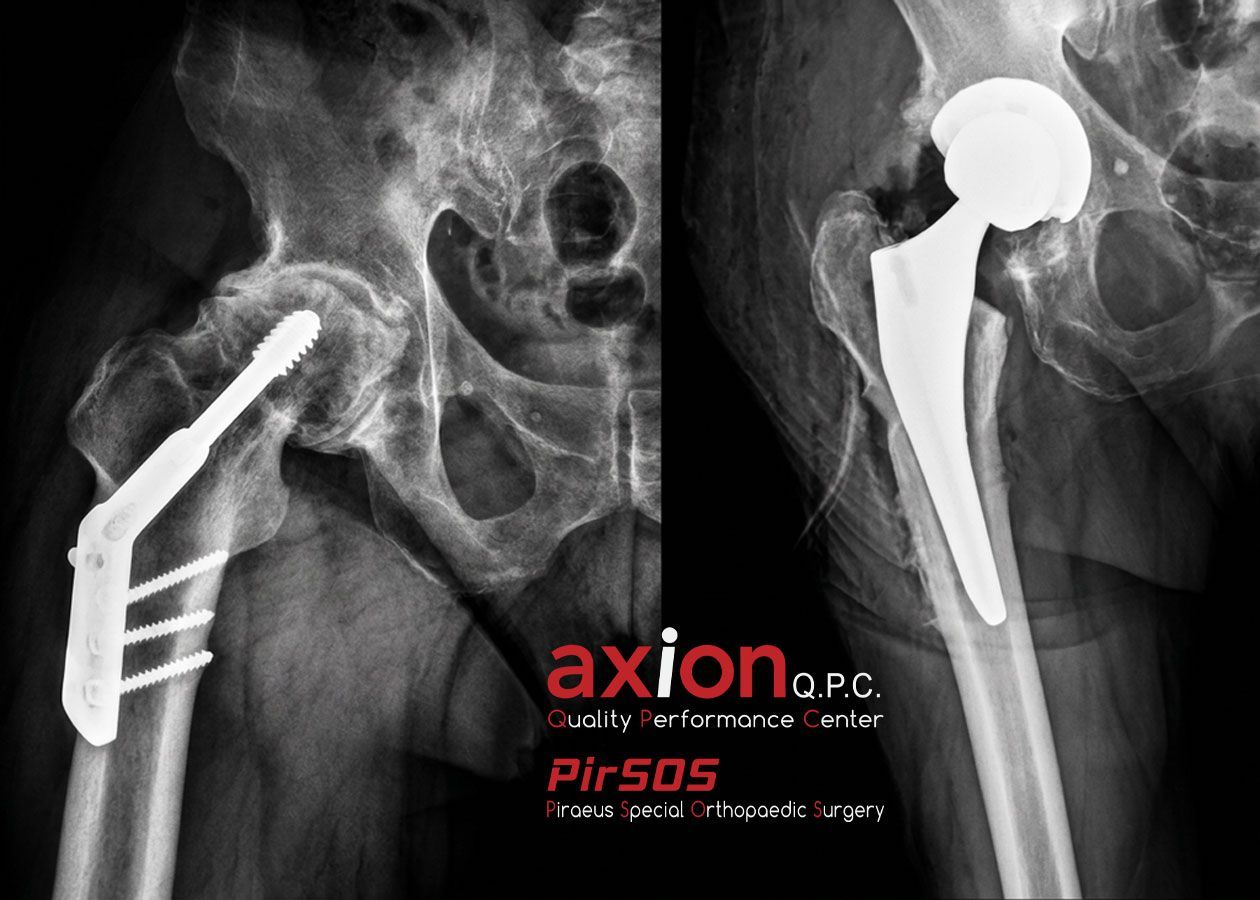 Hip X-ray comparison showing prior fracture fixation and conversion total hip arthroplasty outcome