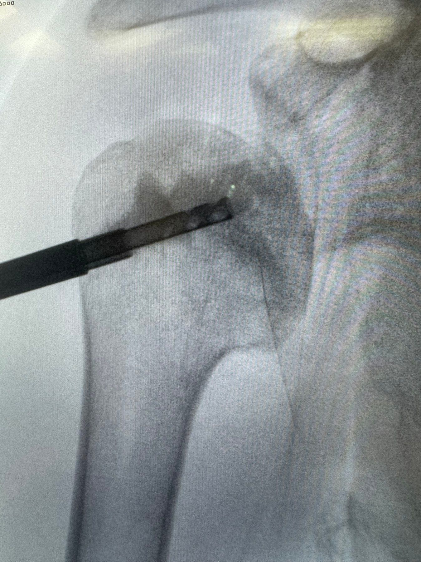 Post-operative imaging — final result view 3