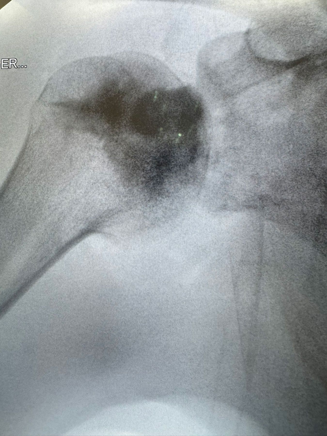 Post-operative X-ray — INNOTERE in place, spherical shape preserved