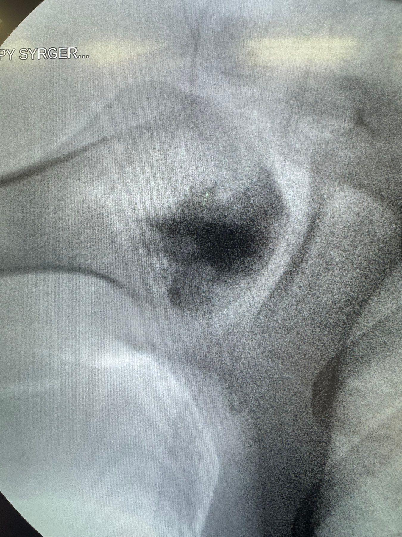 Post-operative X-ray — reinforced humeral head