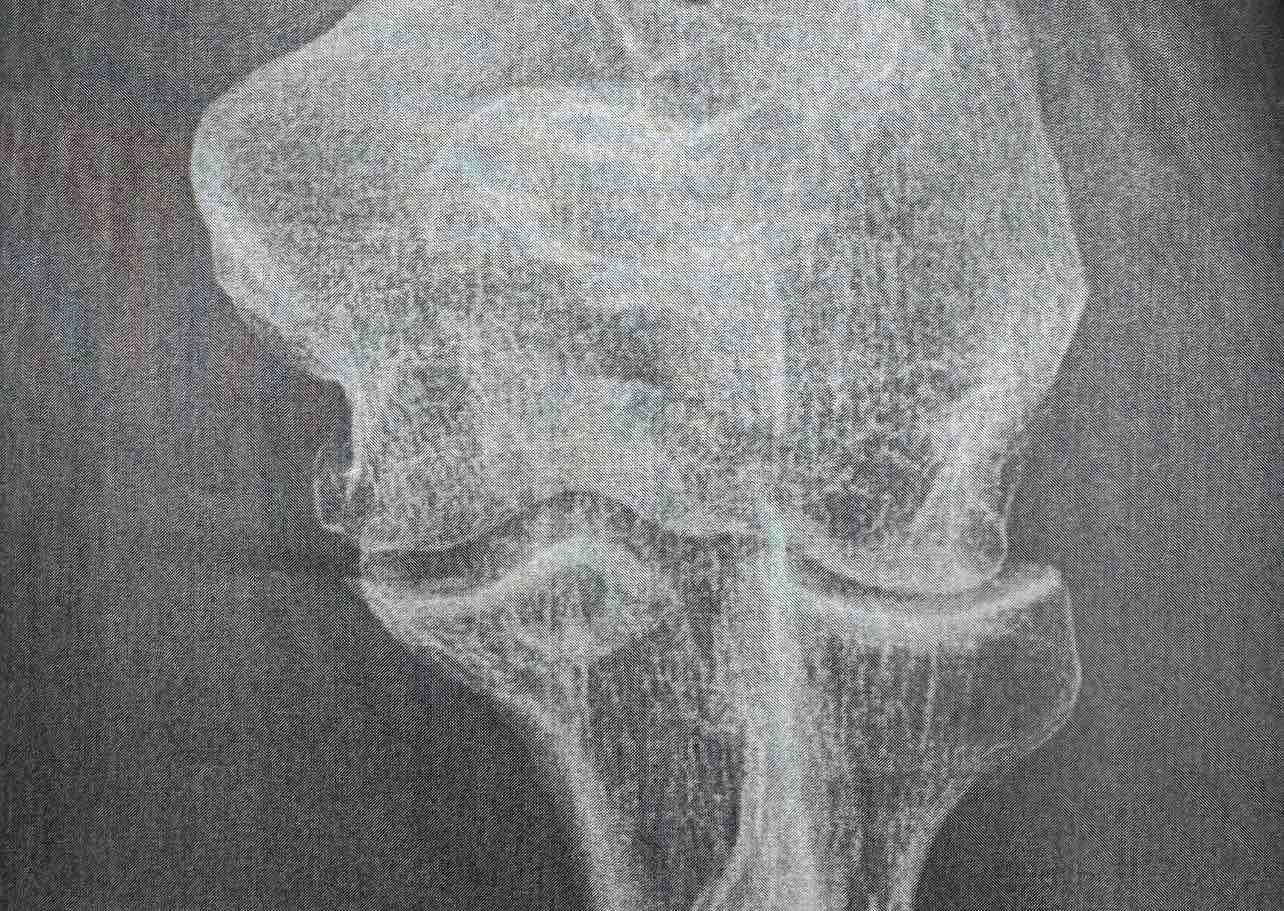 Olecranon fracture X-ray — before (2)