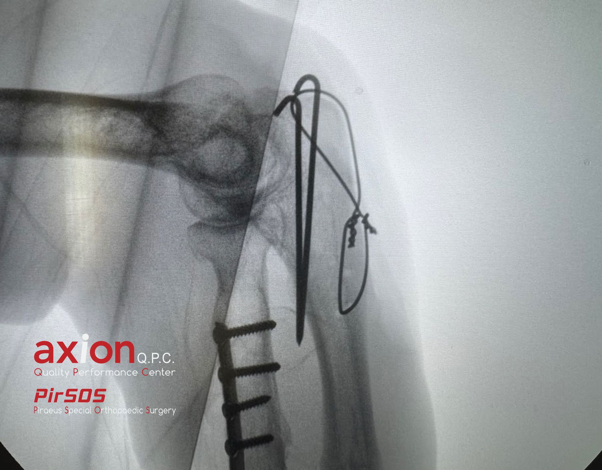 Olecranon fracture X-ray — after (1)