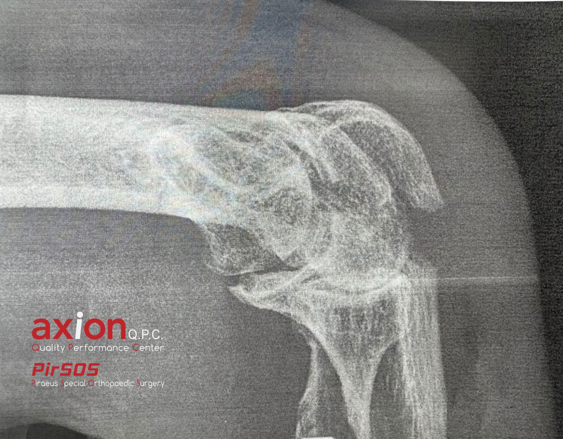 Olecranon fracture X-ray — before (1)