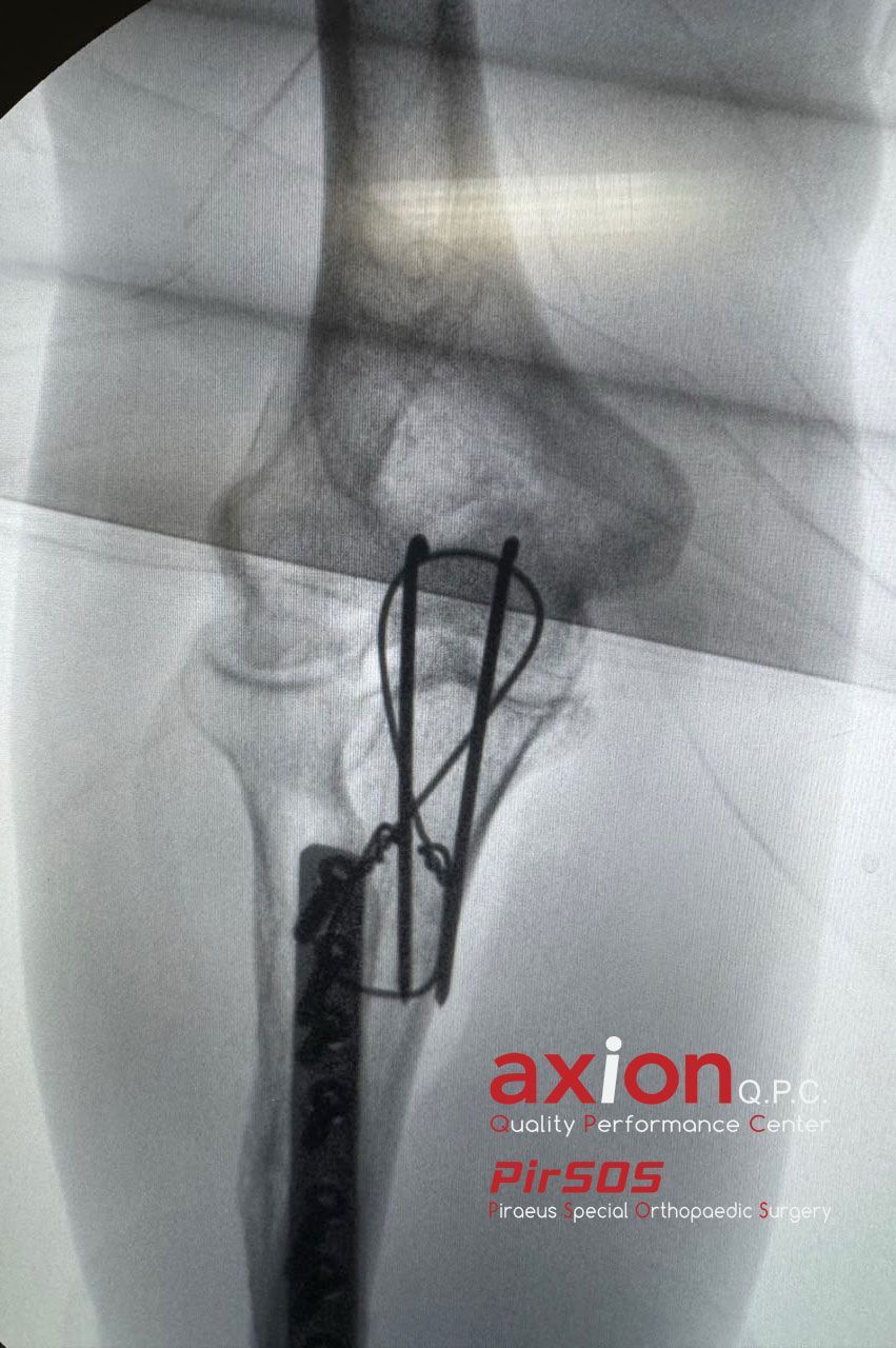 Olecranon fracture X-ray — after (2)