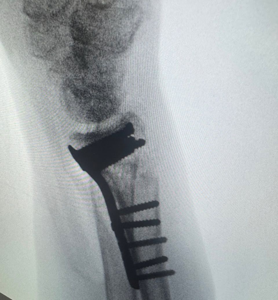 Post-operative wrist image 2