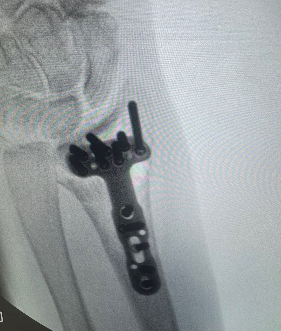 Post-operative wrist image 1