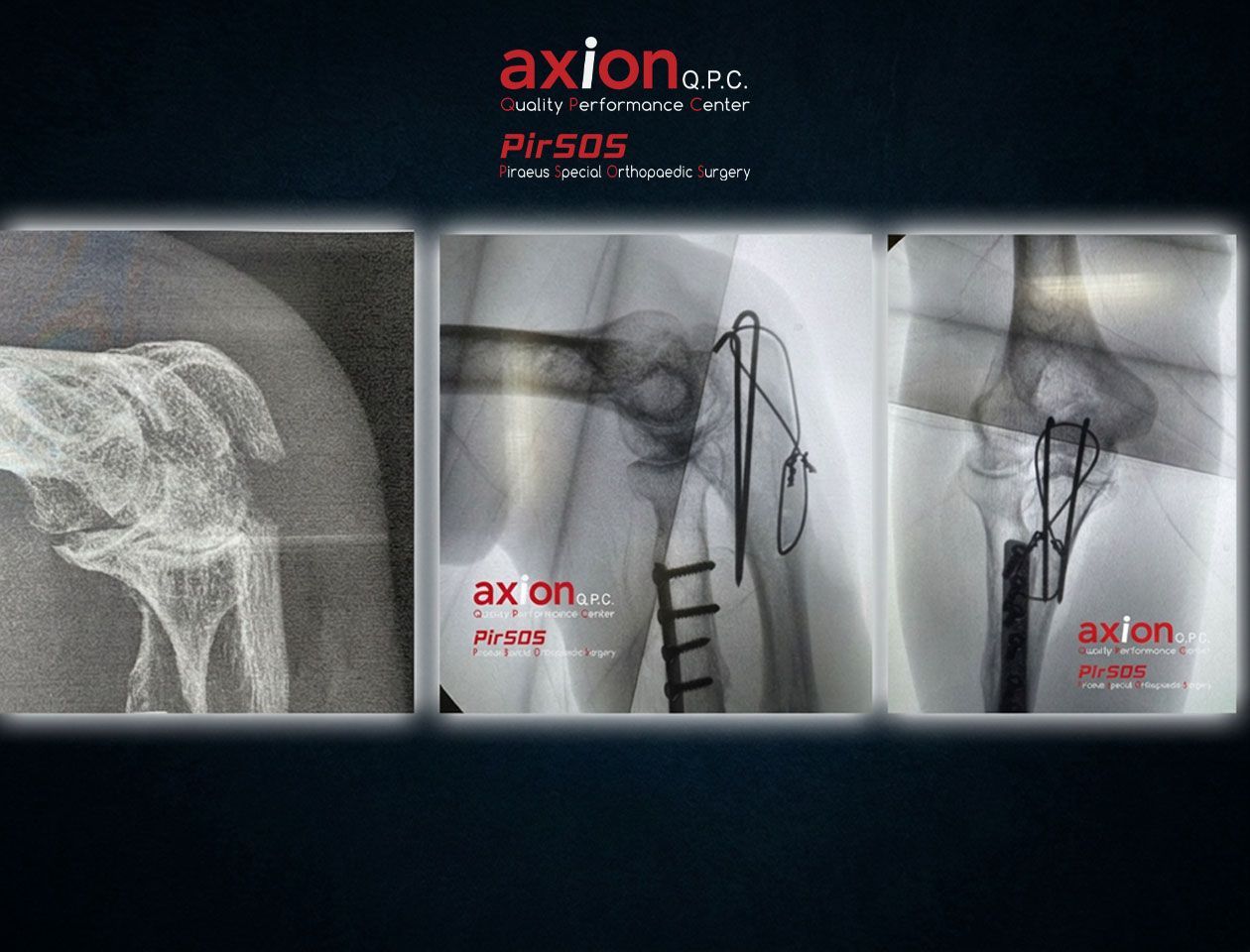 Olecranon fracture X-ray collage showing before and after tension band wiring fixation
