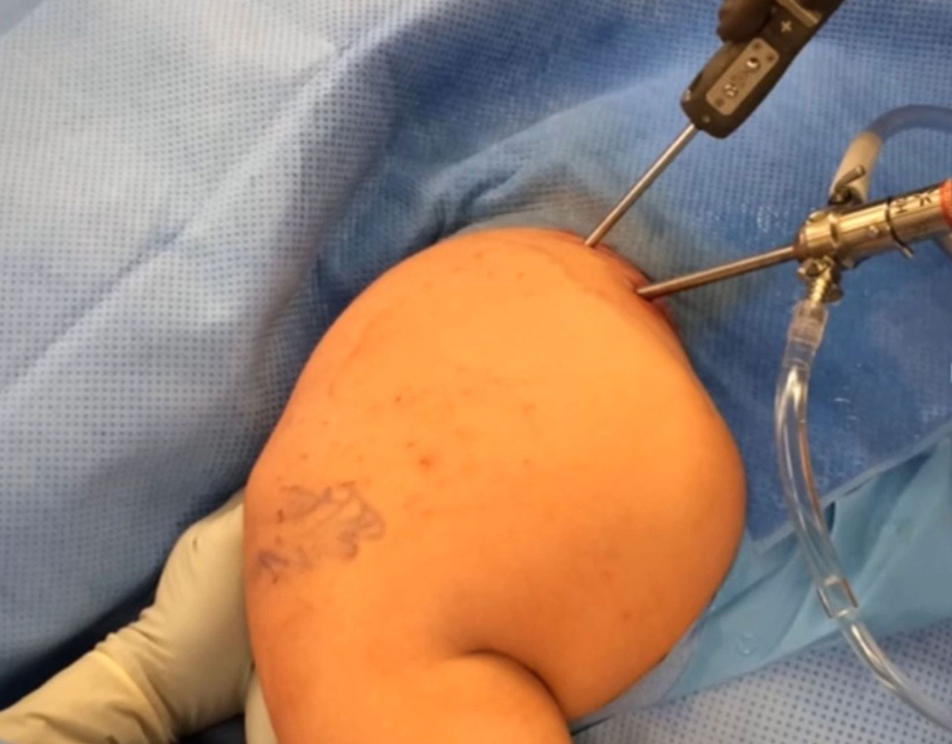 Snapping Scapula - εικόνα 1