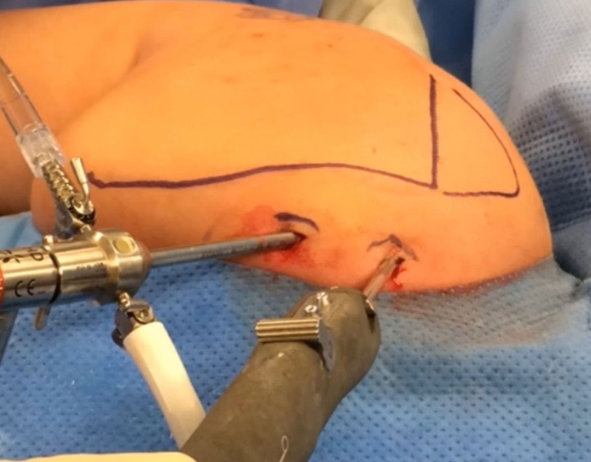 Snapping Scapula - εικόνα 2