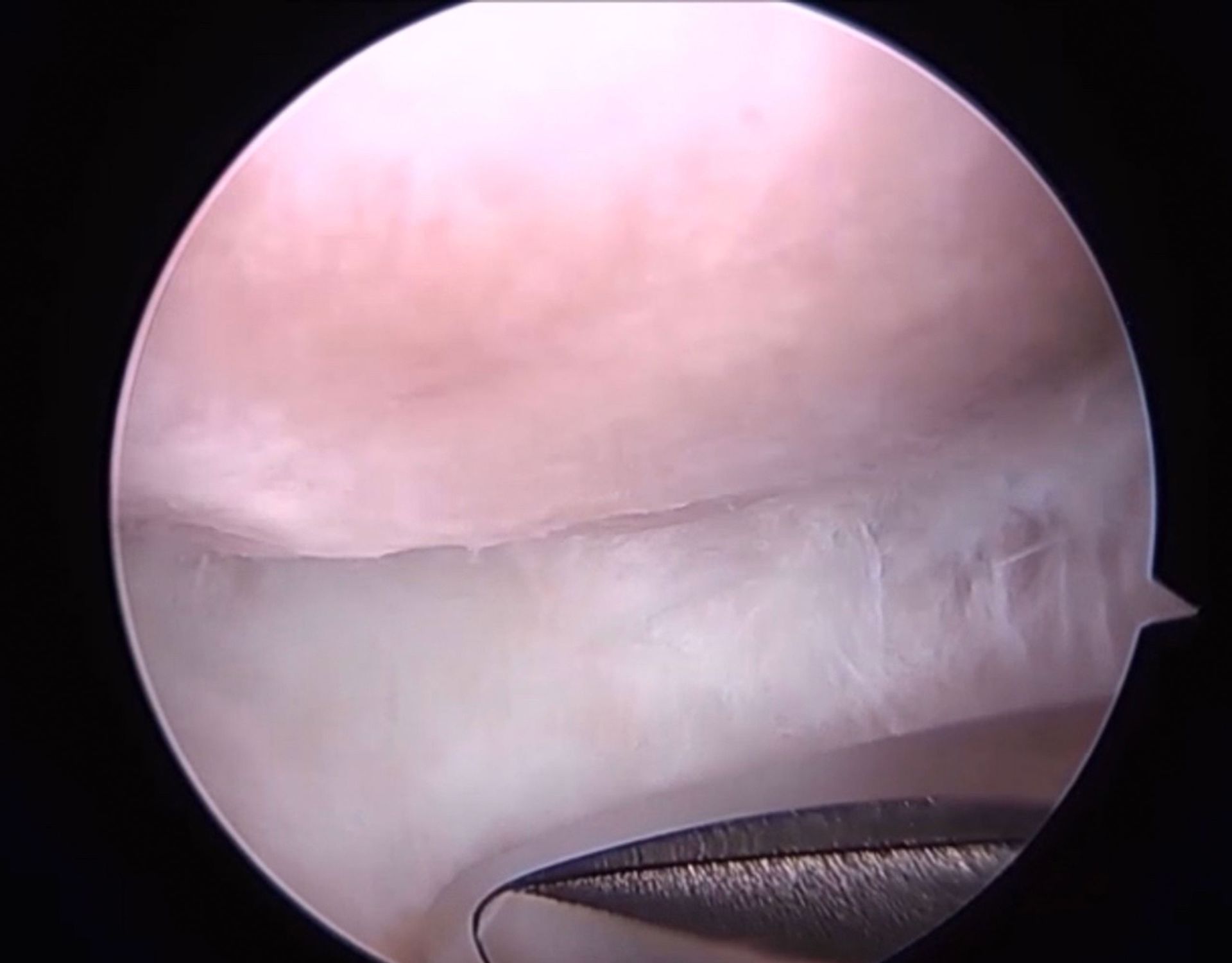 Snapping Scapula - εικόνα 5