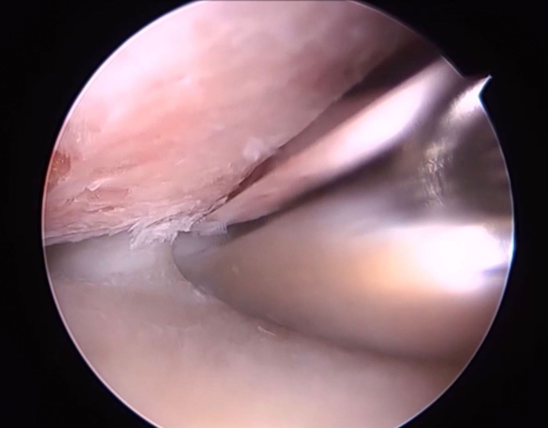 Snapping Scapula - εικόνα 4