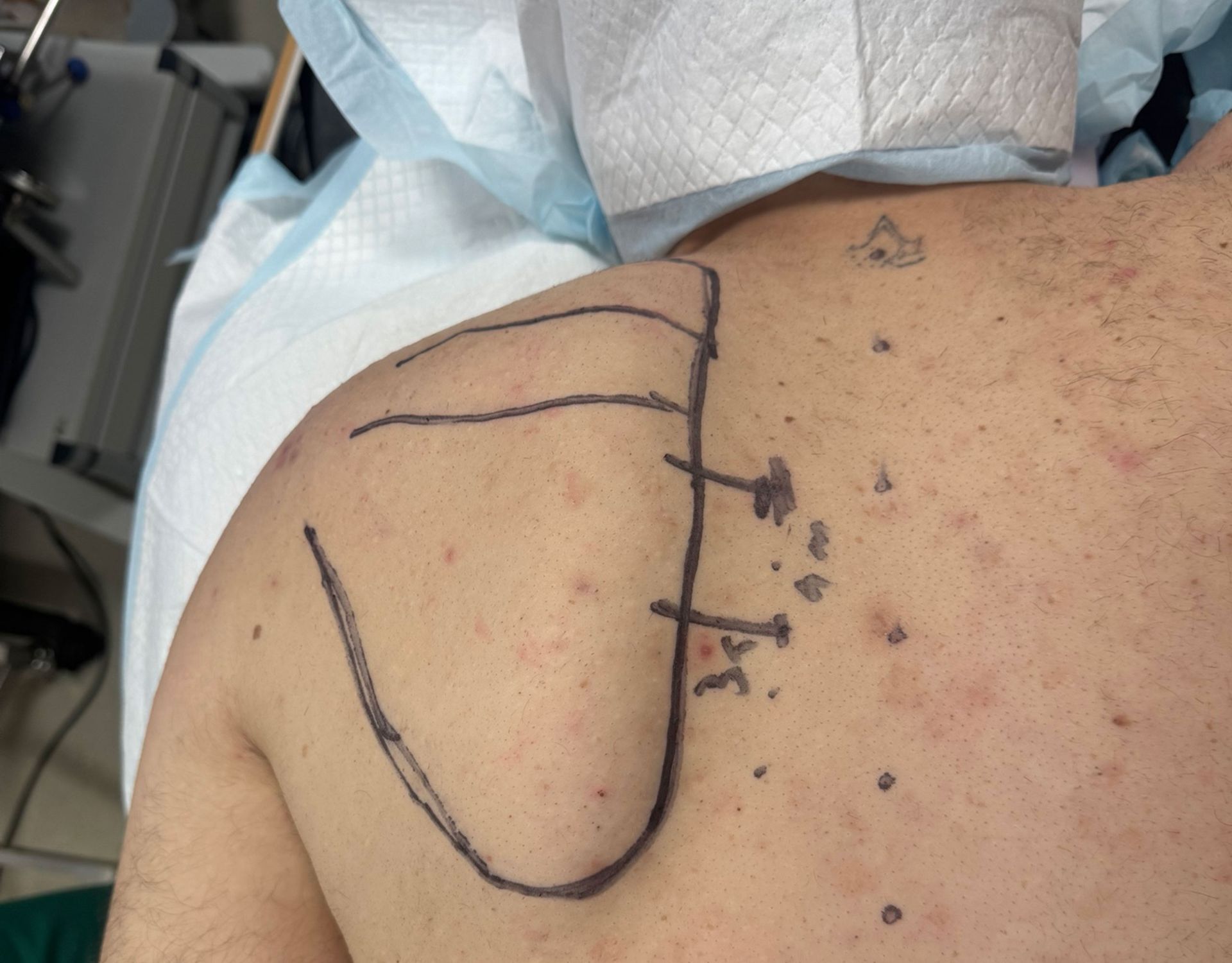 Snapping Scapula - εικόνα 3