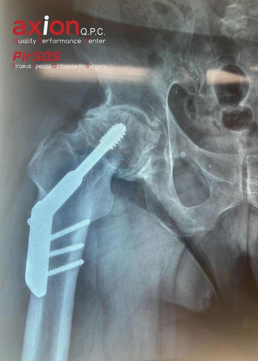Hip X-ray showing prior fracture fixation and post-traumatic arthritis