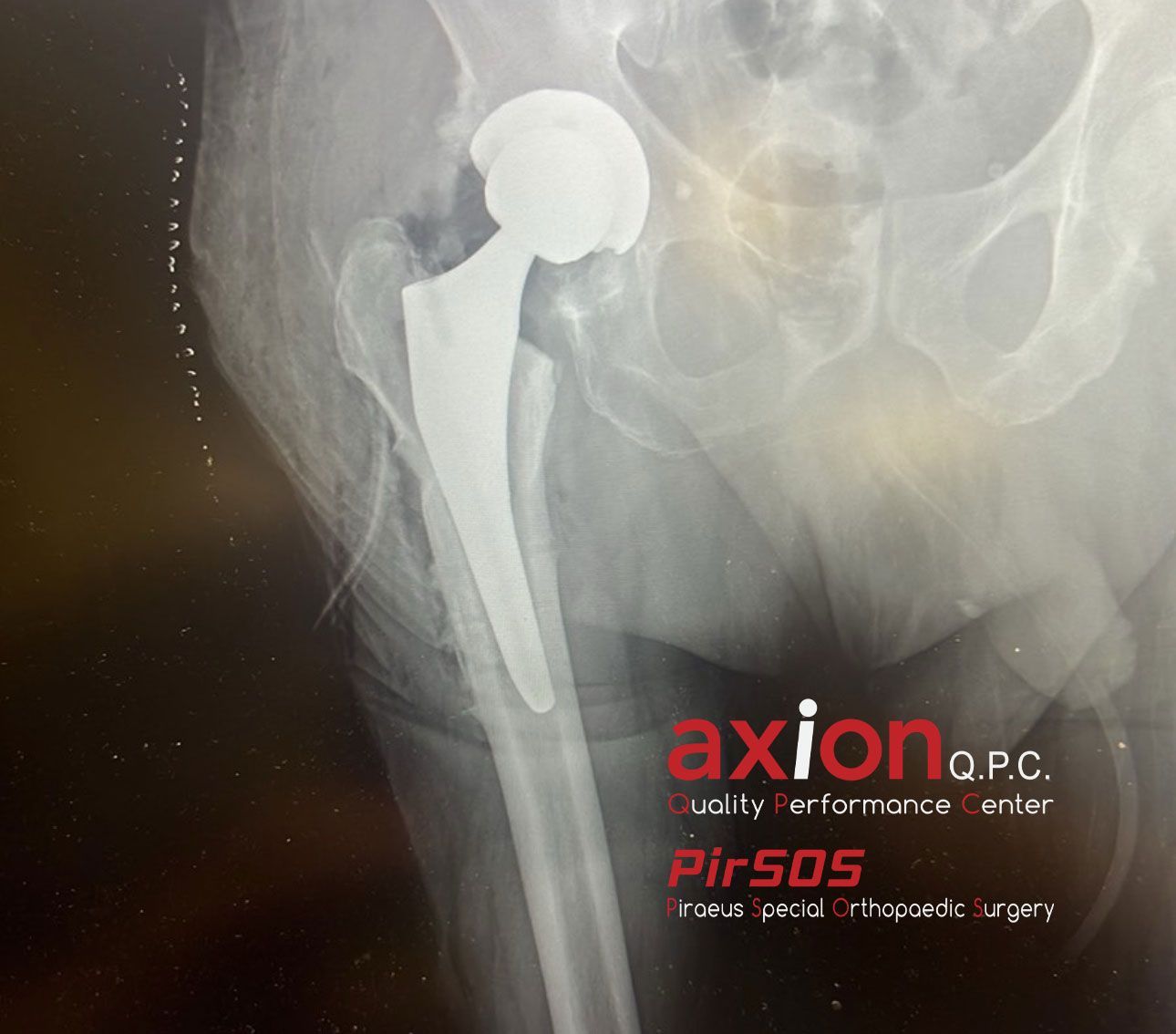 Hip X-ray after conversion total hip arthroplasty