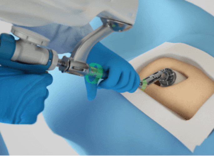 Guía robótica MAKO durante la cirugía