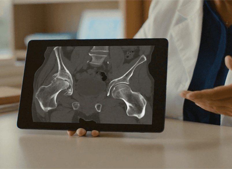 MAKO CT scan ισχίου για προεγχειρητικό σχεδιασμό - Γιατρός εξετάζει τρισδιάστατο μοντέλο ανατομίας