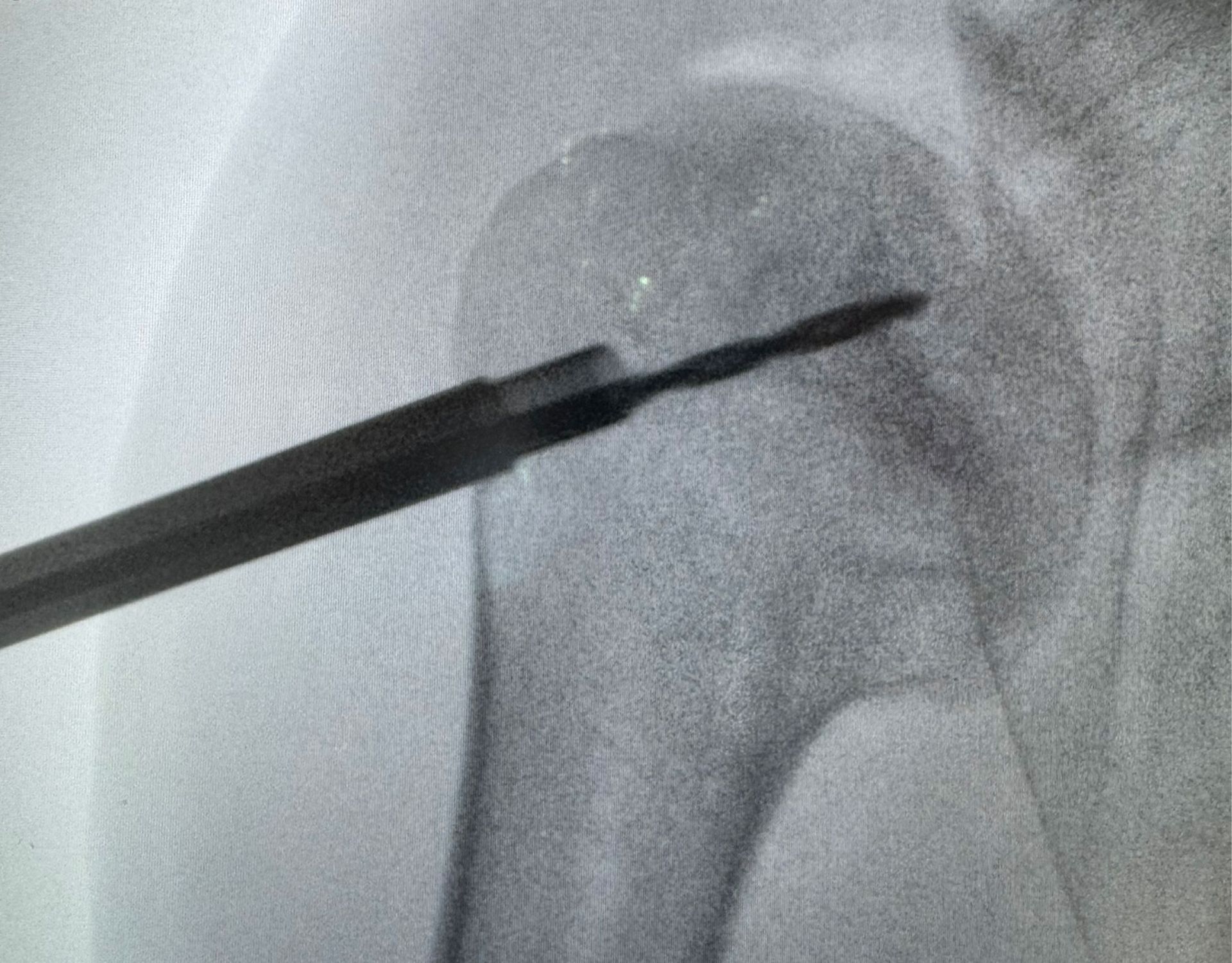 Fluoroscopic guidance — lesion targeting