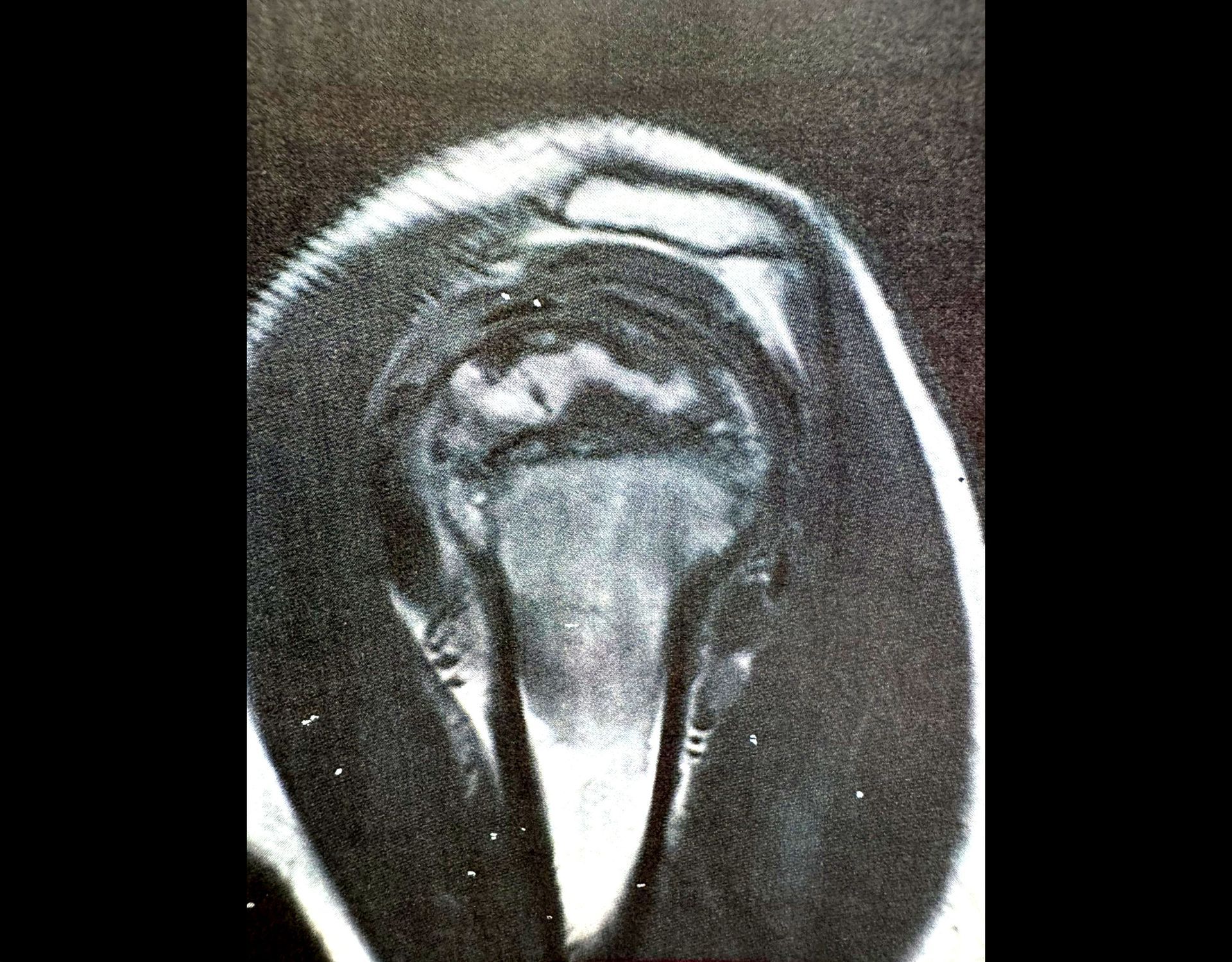 Pre-operative imaging — coronal view