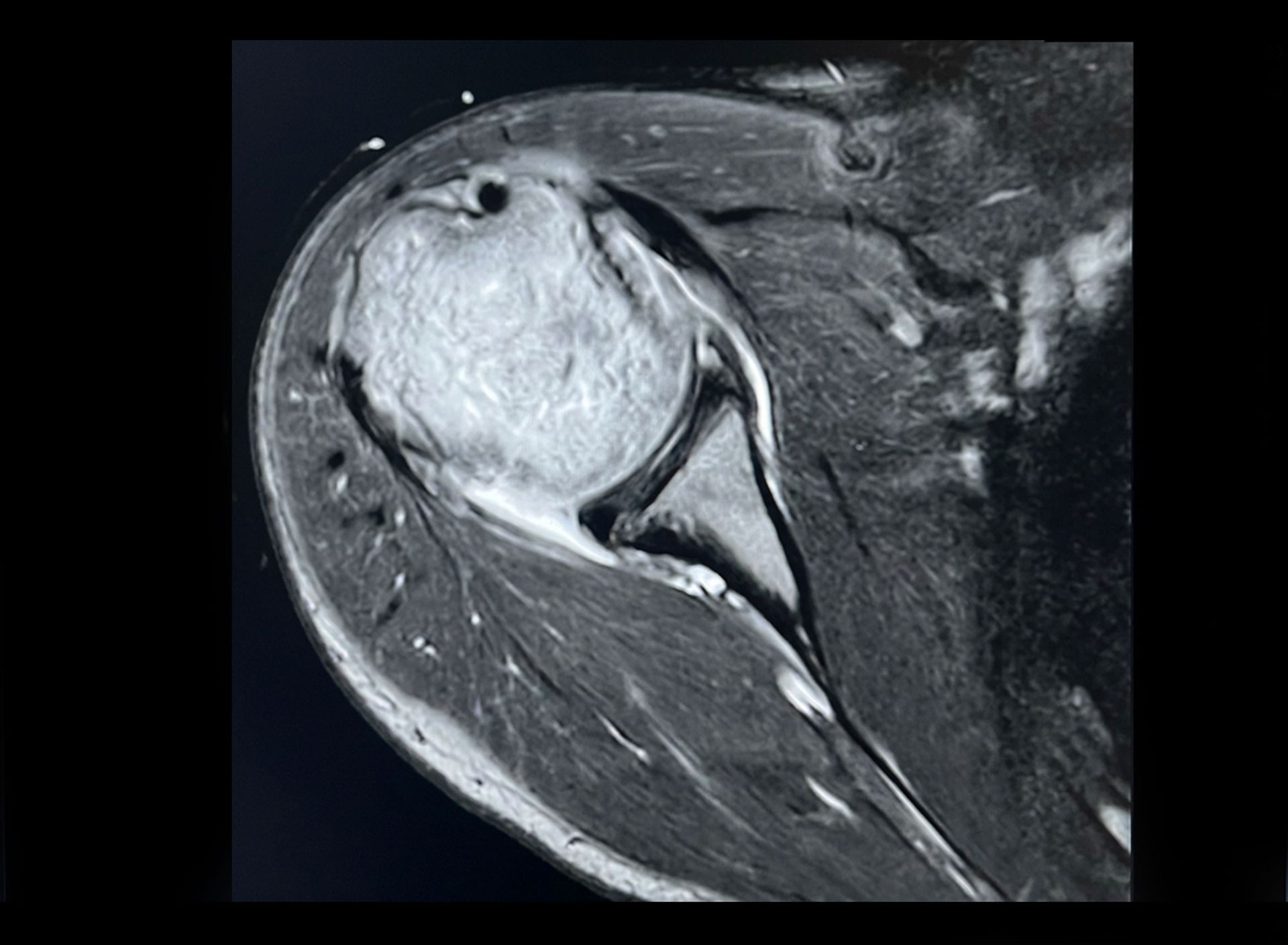 Pre-operative MRI — chondral fissure