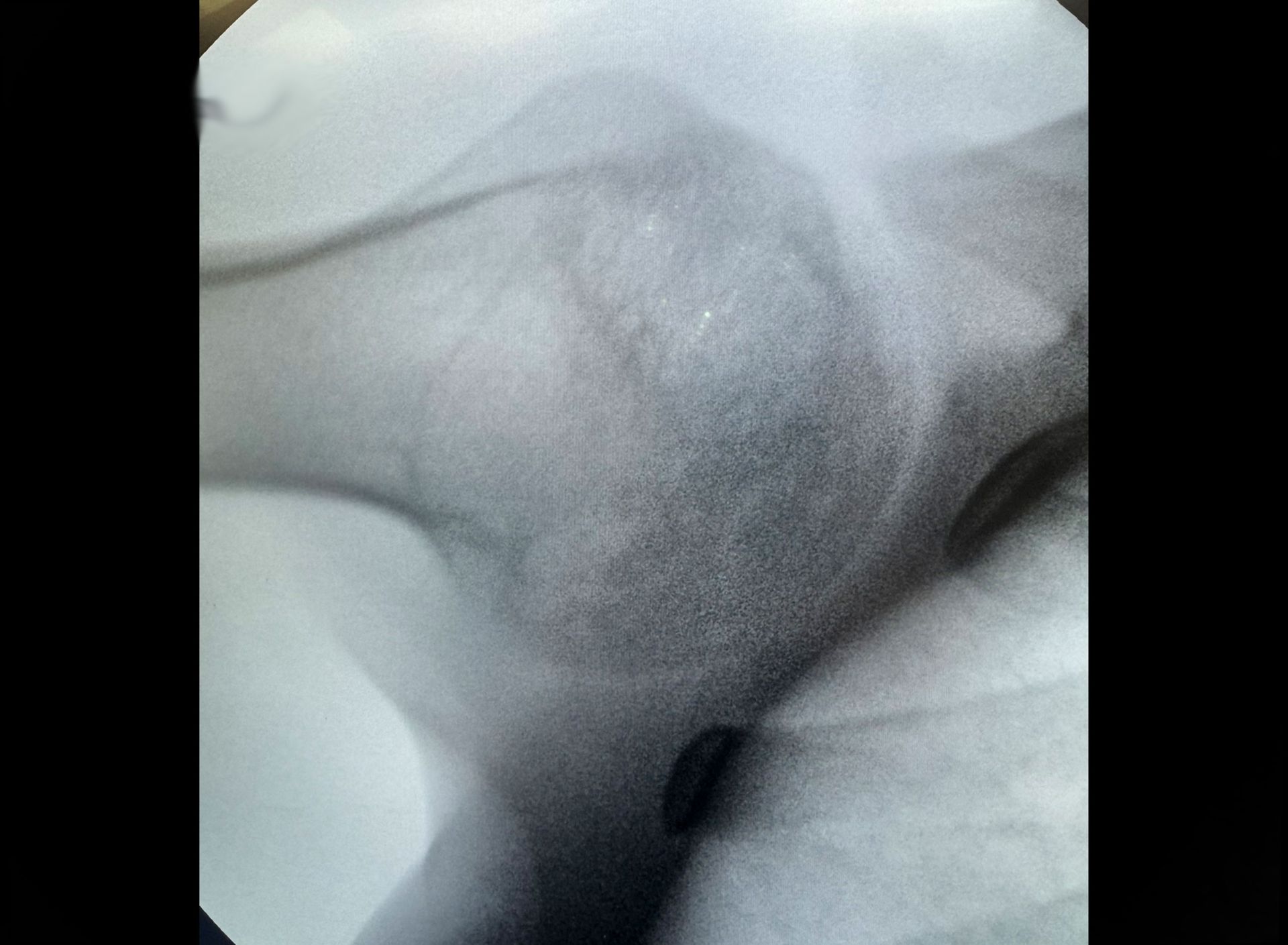 Pre-operative imaging — lesion and fissuration