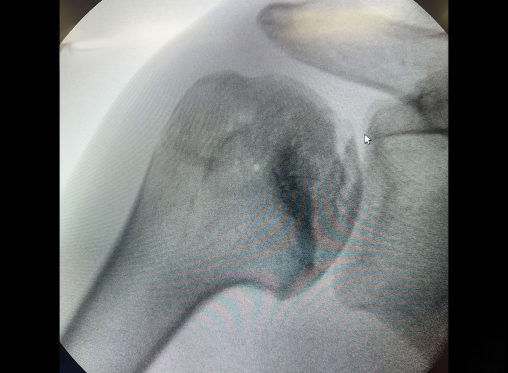 Pre-operative MRI — osteonecrosis grade 3, humeral head