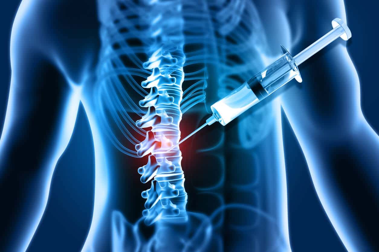 VIA Disc procedure at MD Spine care in San Antonio TX