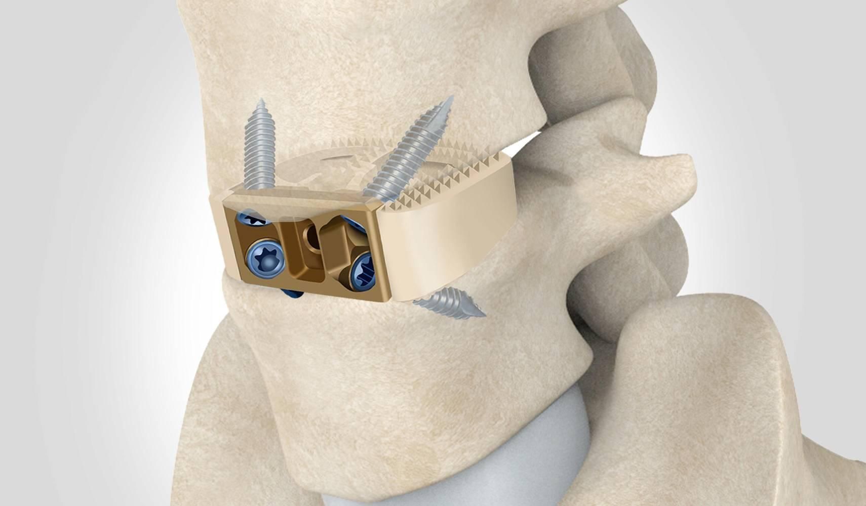 Spinal vertebra with metal implant plate and screws securing a bone fracture