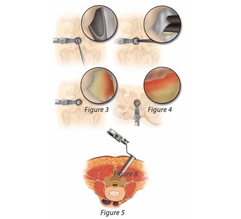 Minimally Invasive Tubular Retractor utilizing METRx system