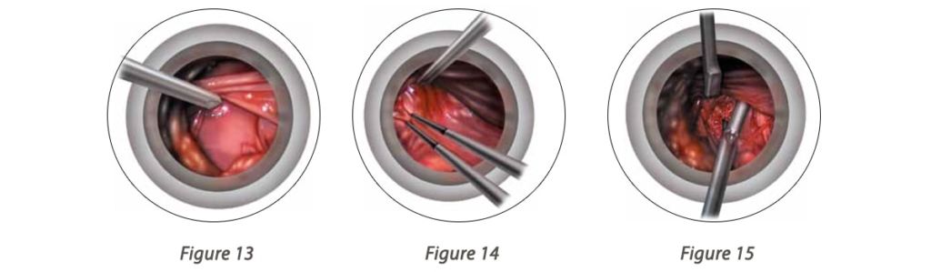 Discectomy and Closure