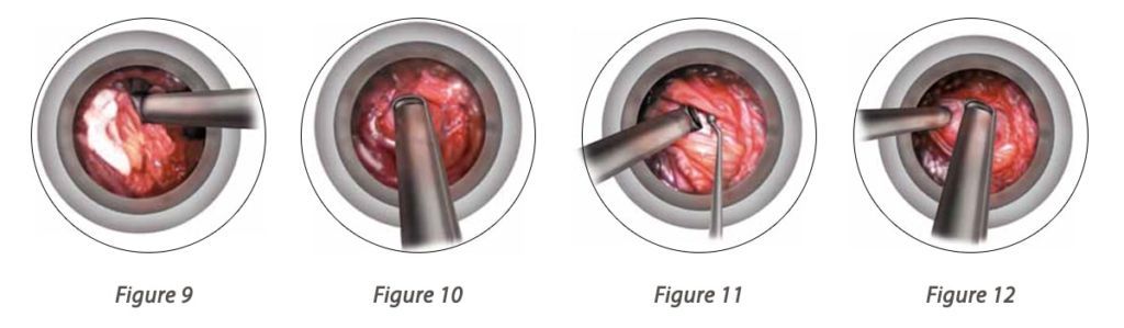 Ligamentum Flavum Removal