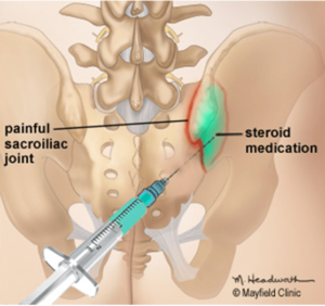 Figure 2. A needle is gently guided into the sacroiliac joint using x-ray fluoroscopy.