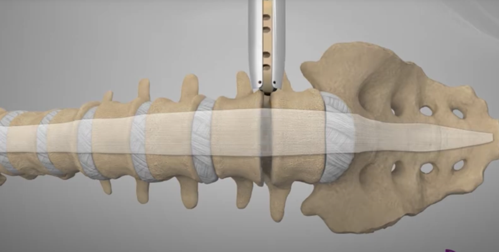 XLIF Procedure