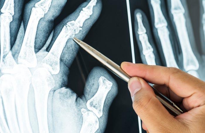 DRA. DESIRÉE SEPÚLVEDA ALDANA - OSTEOPOROSIS