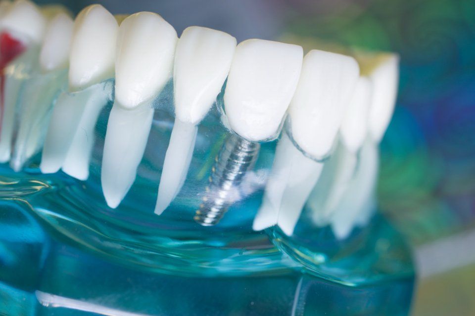 Impianti dentali