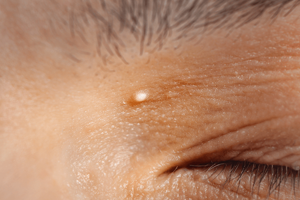 Milia on Eye Lid