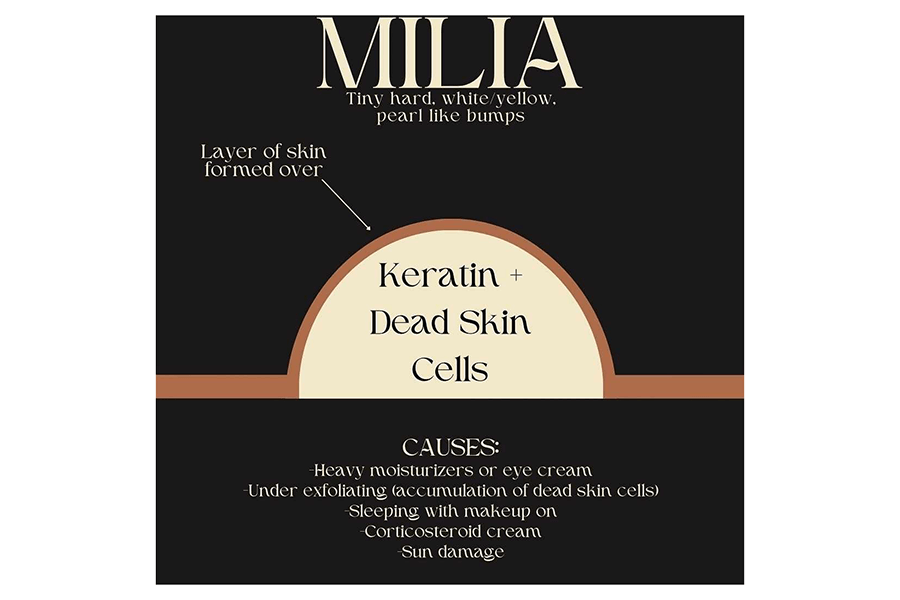 Milia Infographics