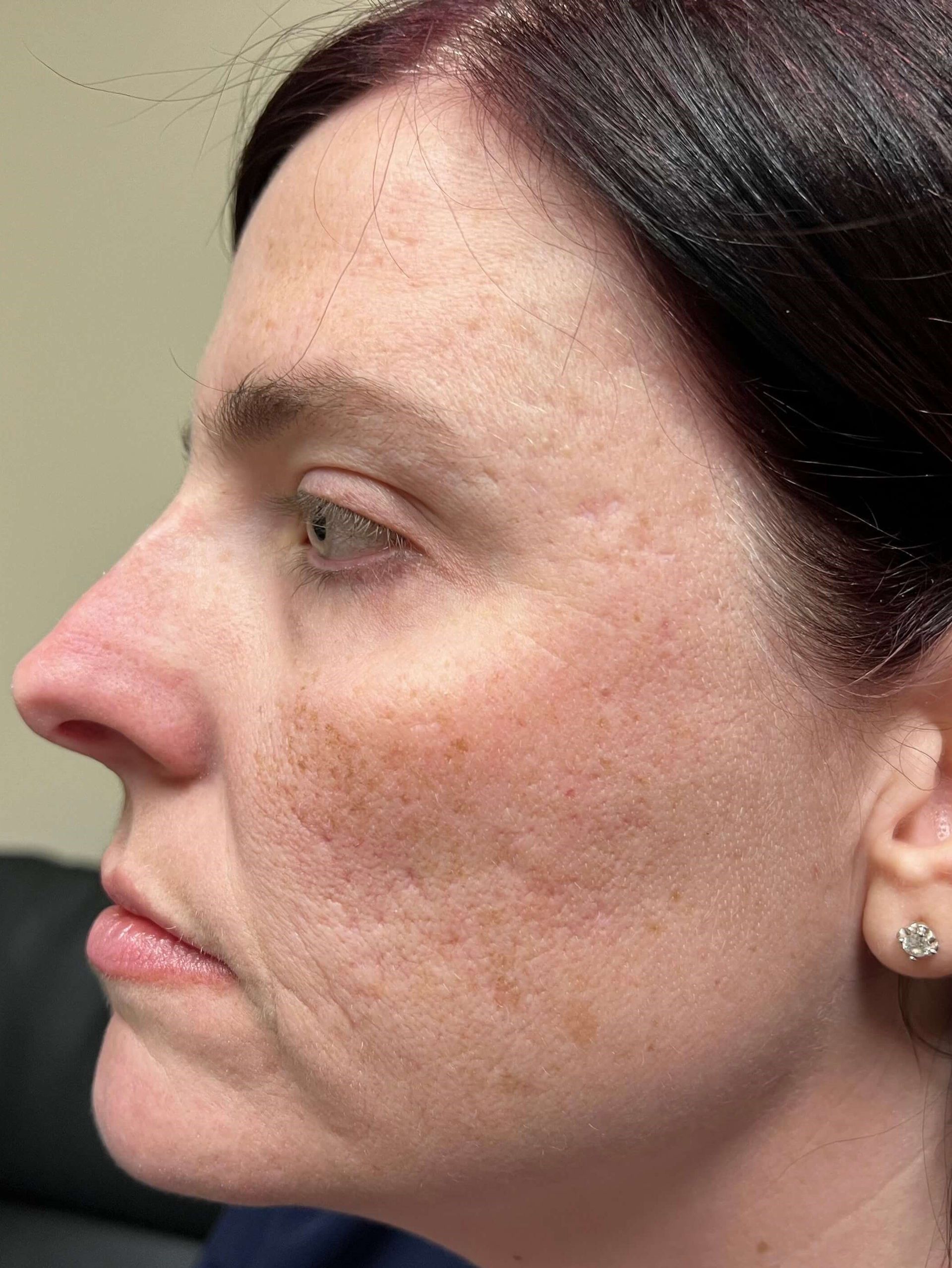 Before Pimple Marks Skin Resurfacing
