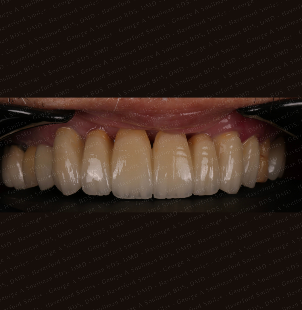 Anterior mouth Rehabilitation - Upper and Lower Bridgework after