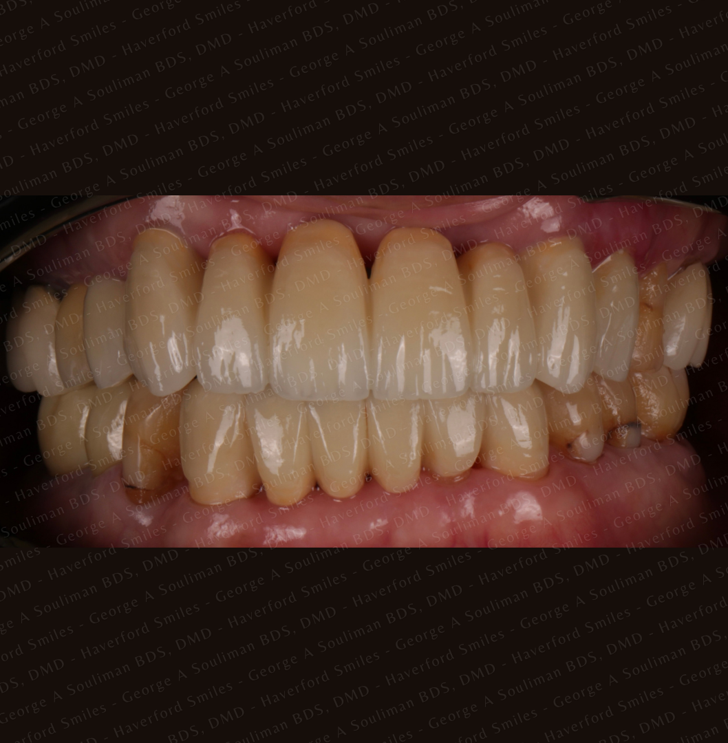 Anterior mouth Rehabilitation - Upper and Lower Bridgework after