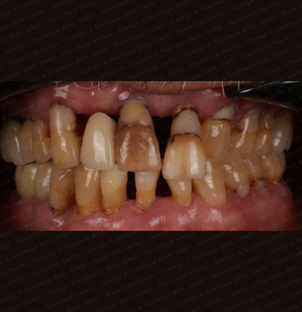 Anterior mouth Rehabilitation - Upper and Lower Bridgework before
