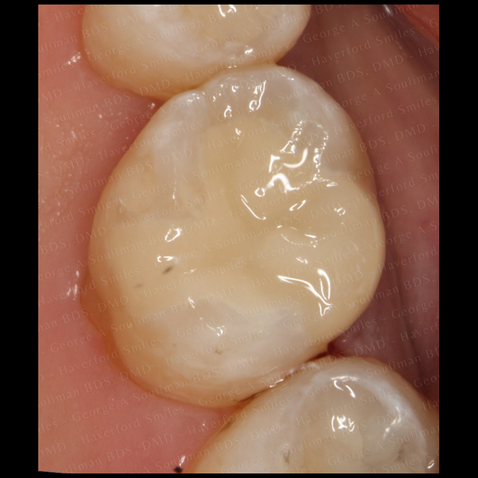 Ceramic Onlay before