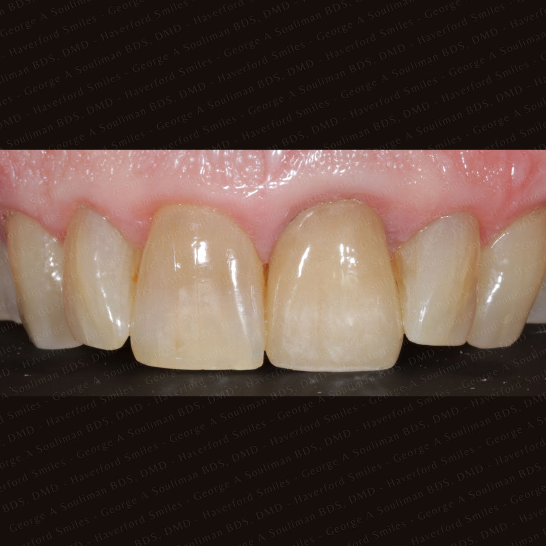 front ceramic crown after