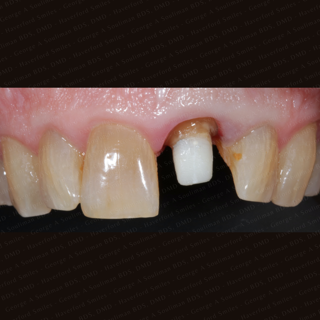 front ceramic crown before